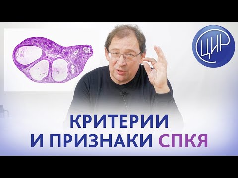 СПКЯ. Критерии и признаки СПКЯ (синдрома поликистозных яичников). Гузов И.И.