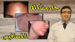 Fungal Acne الحبوب الفطرية (الفسافيس)