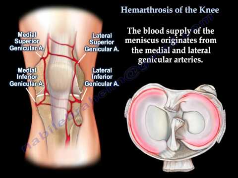 Video: Hemarthrosis Of The Knee Joint - Symptoms, Treatment