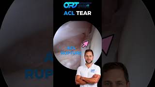 🦵⚠️ ACL Tear: When Knee Stability Is Lost
