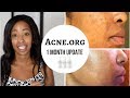 MY ACNE STORY| ACNE.ORG ONE MONTH REVIEW