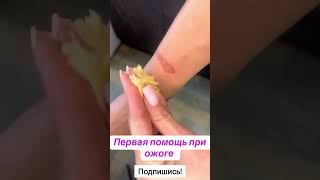 Первая помощь при ожоге🔥#перваяпомощь #ожоги