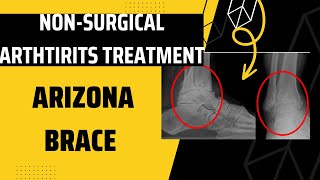 Non-surgical Arthritis treatment - Arizona brace