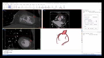 Tutorial: Coronary Vessel Segmentation