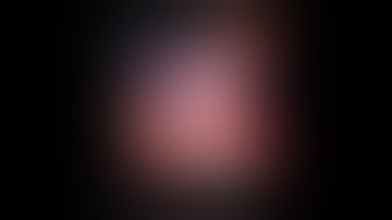 Partial nephrectomy- Da Vinci System