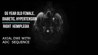 Magnetic Resonance Imaging Mri In Acute Middle Cerebral Artery Mca Ischemic Stroke