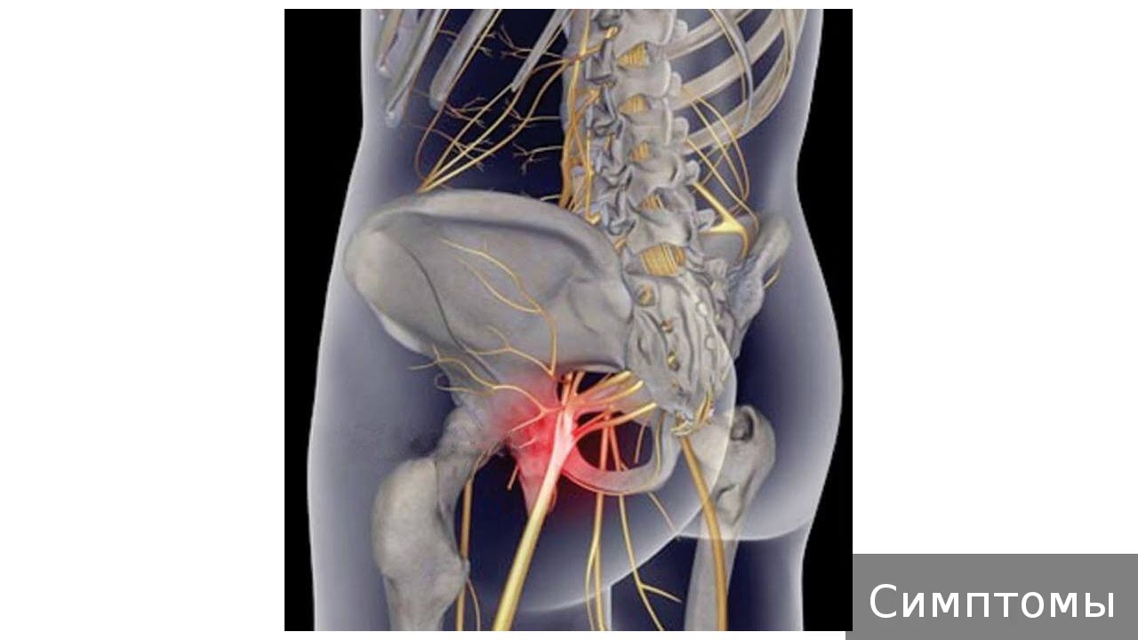 Седалищный нерв симптомы у мужчин как. Ишиас седалищного нерва. Ишиас седалищного нерва симптомы. Ишиас - защемление седалищного нерва.
