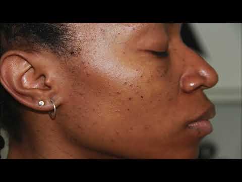 Abnormal Growths, Skin Cancers, and Treatments Phoenix, AZ 1 hqdefault