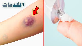 مرهم لعلاج الكدمات الزرقاء ، وطرق علاجها في المنزل