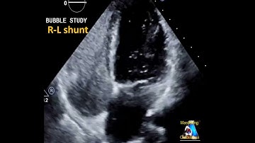 Bubble test (agitated saline) positive: R-L Shunt #shorts