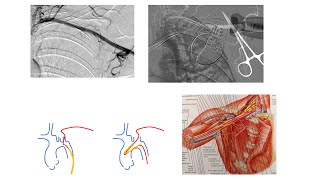 Axillary balloon pump (+Impella): step-by-step access, exchange, closure, complications- Elias Hanna