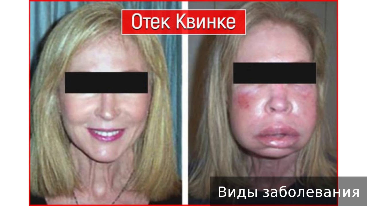 Ангионевротический отек. Как лечить ангионевротический отек. - YouTube