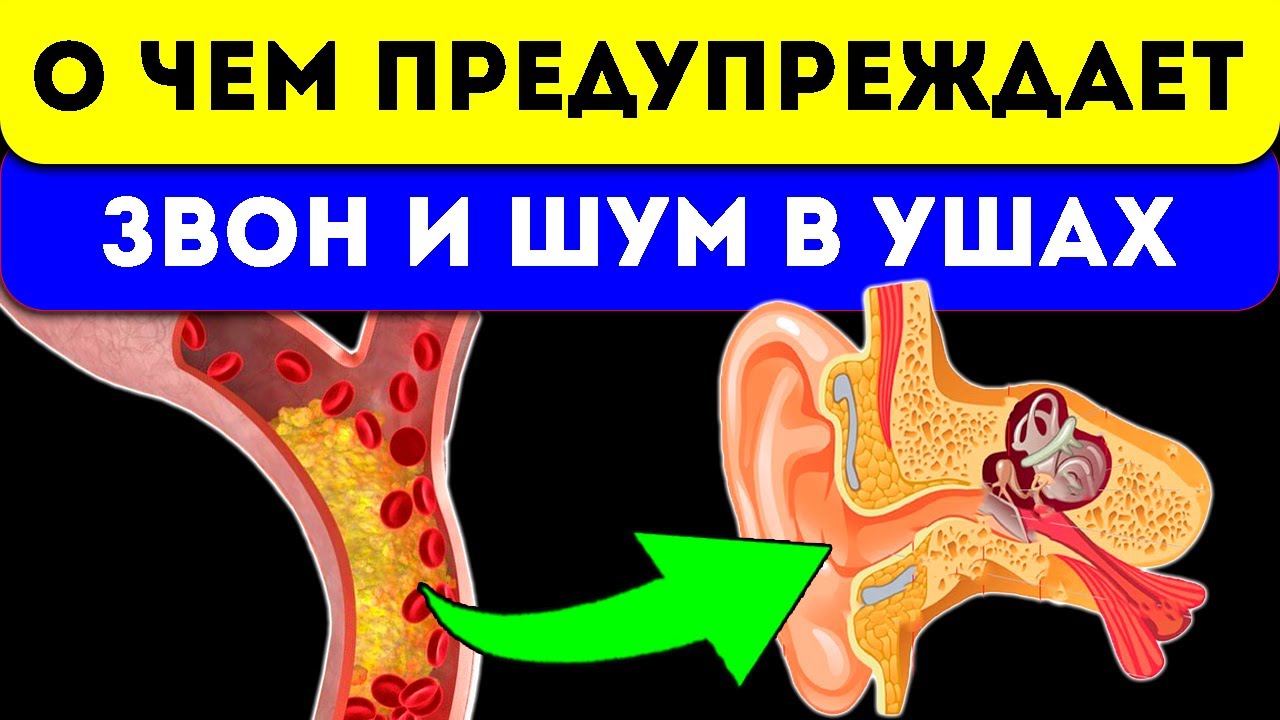 Писк в левом ухе. Шум в ушах причины. Звон в ушах причины. Постоянный шум в ушах причины. Тиннитус шум в ушах.