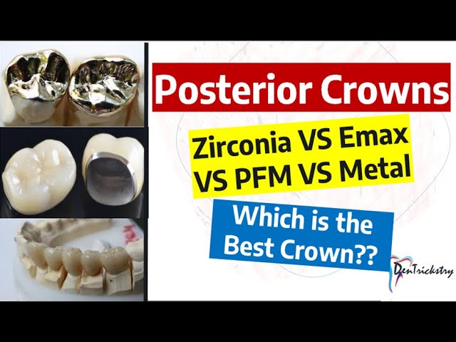 Outline Video DENTAL CROWN TYPES. Zirconia, Emax, PFZ, PFM, Metal!! Choosing the BEST!