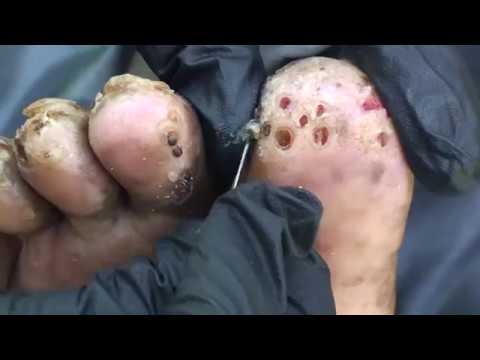 jiggers, worst skin diseases, bugs, tropical diseases, poverty, Kenya, ndur...