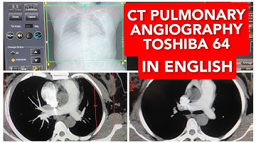 CT Pulmonary Angiography on Toshiba 64 Slice.