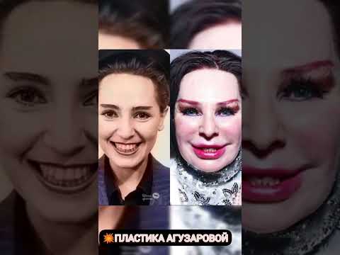 ПЛАСТИКА АГУЗАРОВОЙ💥 жизнь знаменитостей