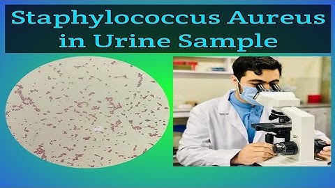 Staphylococcus aureus in Urine sample Under Microscope (Urinary Tract Infection)
