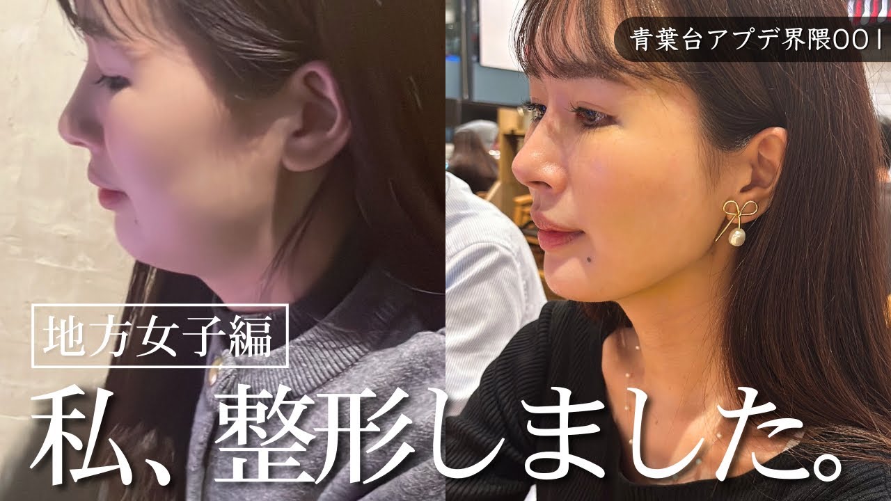 【ダウンタイム記録】輪郭形成のリアル｜脂肪吸引・脂肪注入・糸リフトでフェイスラインはどう変わる？実際の変化をお見せします！