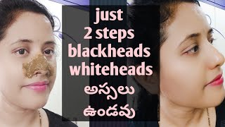 How to remove blackheads permanently at home in telugu| Get rid of blackheads |blackheads in telugu