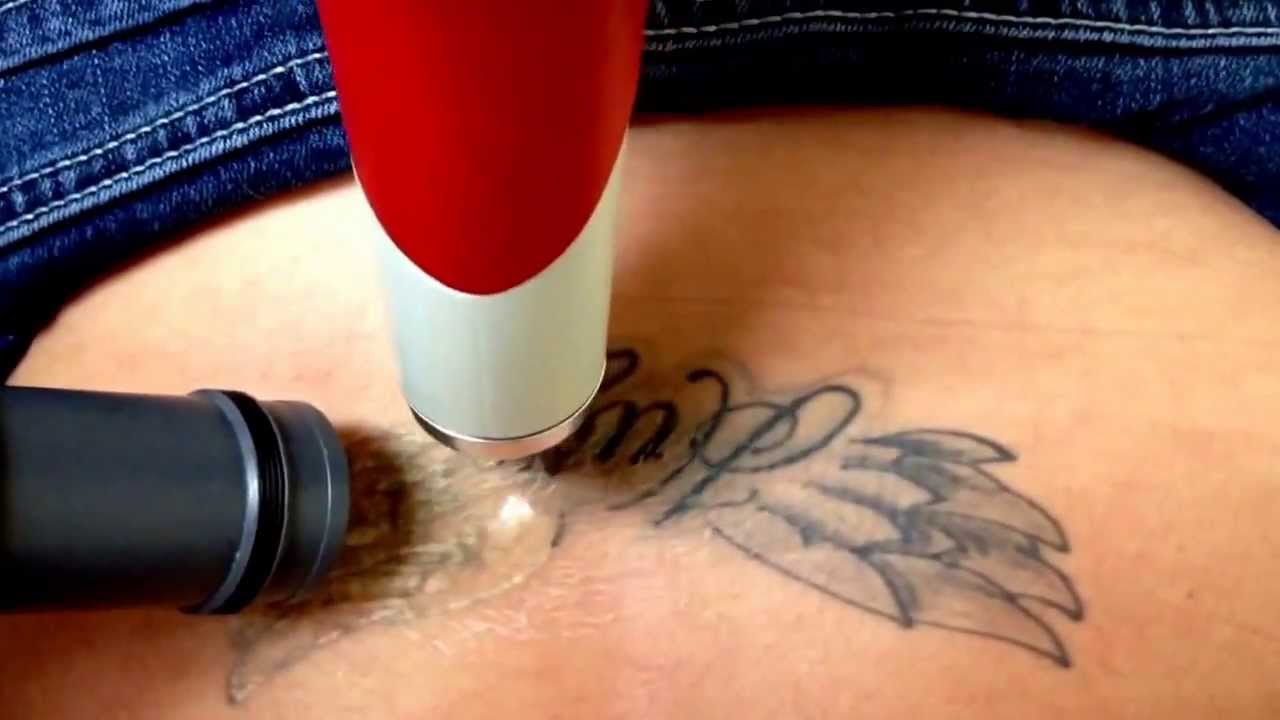 Sugar Land Laser Tattoo Removal  Home  Facebook
