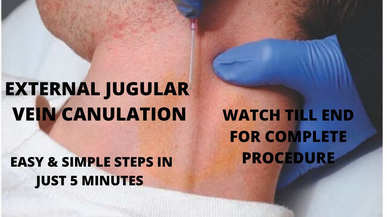 External Jugular Vein Cannulation Procedure With Simplified Steps