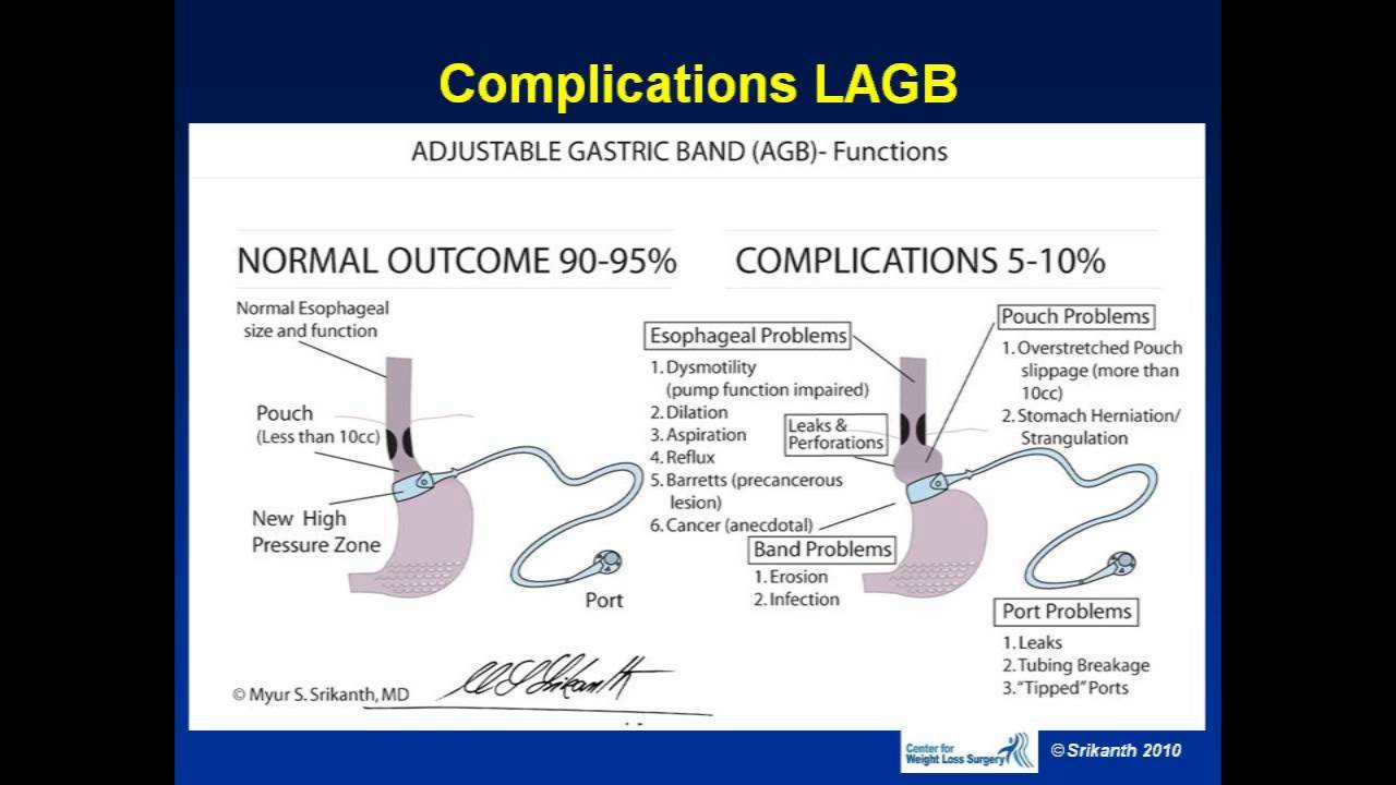 Dr. Srikanth Weight Loss Surgery Seminar Possible