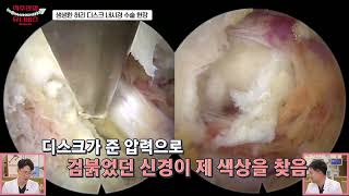 척추내시경 감압술-디스크 제거술편 시술영상