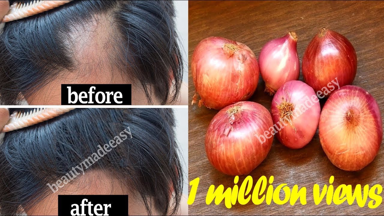 Grow your Hair Faster with Onion Juice | STOP Hair Fall with Home