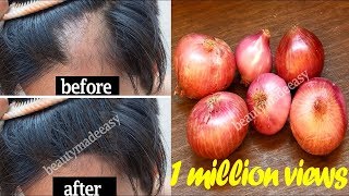 Grow your Hair Faster with Onion Juice | STOP Hair Fall with Home Remedy | 100% Working