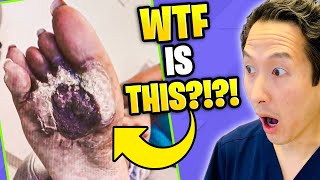 Plastic Surgeon Reacts to MY FEET ARE KILLING ME - Foot CRATER!
