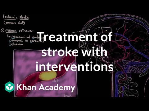 Treatment of stroke with interventions | Circulatory System and Disease | NCLEX-RN | Khan Academy