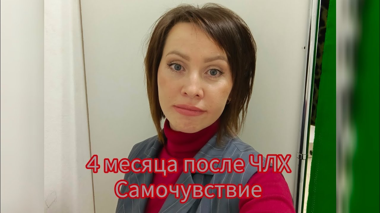 #25 Спустя 4 месяца после ортогнатической операции.