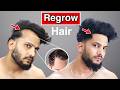 How To Regrow Hair Naturally For Men How To Make Hair Thick And Dense Pawan Yudi Khatri 