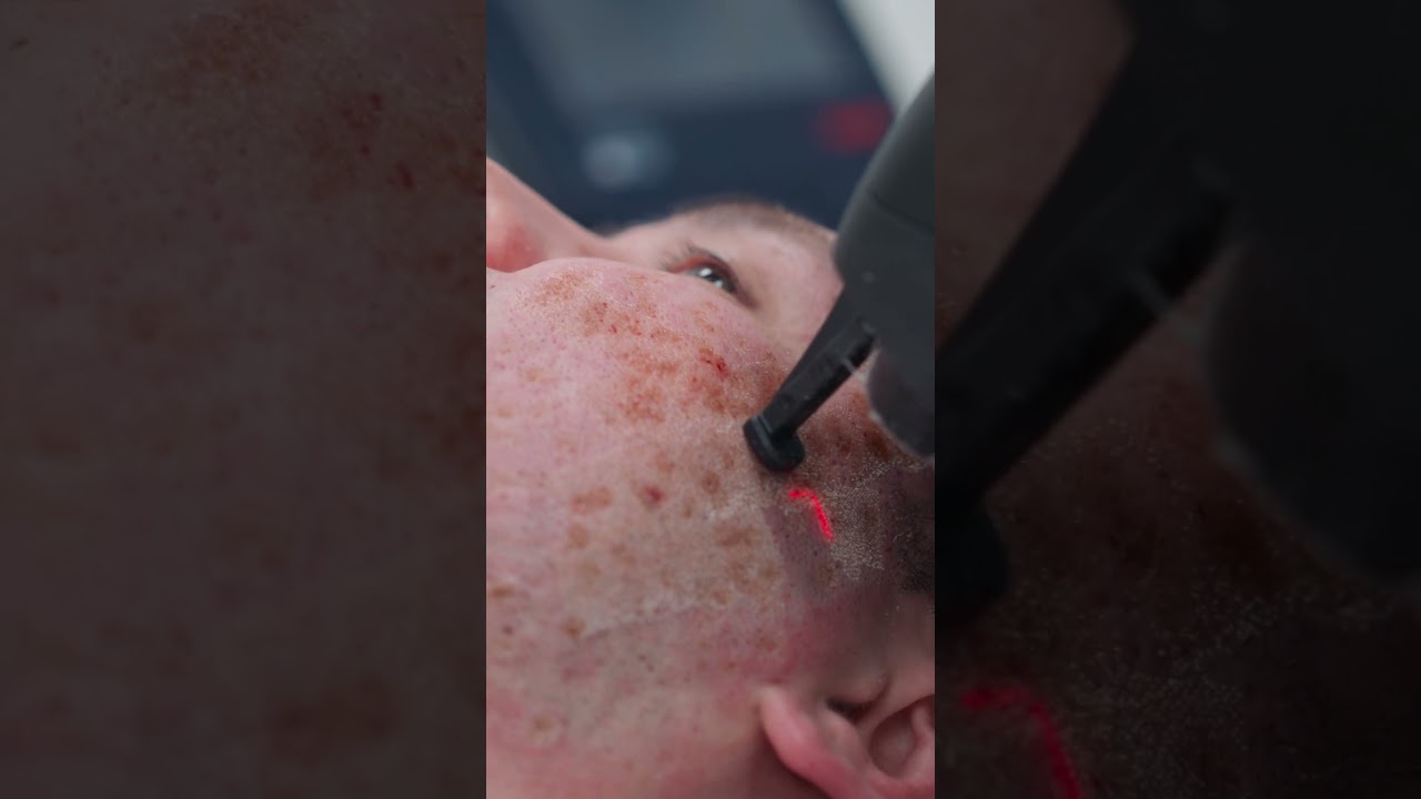 Лазерная шлифовка СО2 для Dr.Rustam