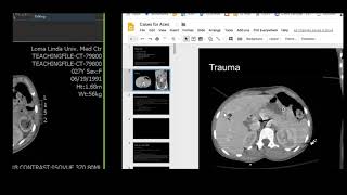 CT artifact from photon starvation