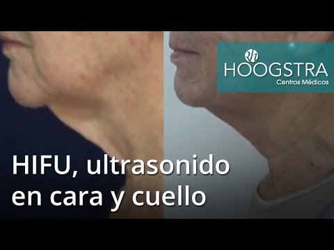 lifting de cuello chile HIFU, ultrasonido en cara y cuello (18127)