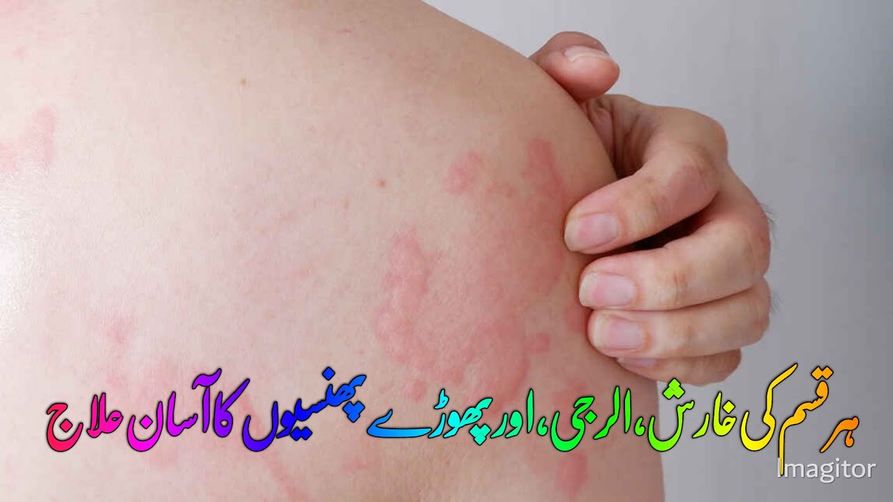 Kharish Ka Asan Ilaj Skin Allergy Easy Herbal Treatment Skin