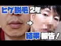 【ヒゲ脱毛】2年間、計13回分の脱毛効果を紹介します!【ゴリラクリニック】