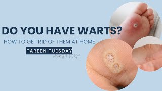 How to Remove Warts and What Causes Them | Dermatologist Explains