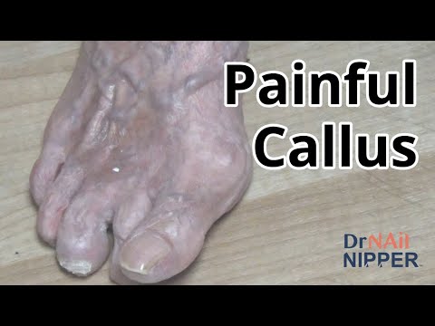 How to Treat a Painful Callus? Or remove? FEET-ure Friday (2021)