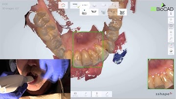 3D BioCAD - Implant Scanning with TRIOS 3