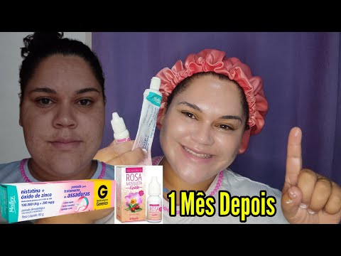 Resultado de 1 Mês Usando Nistatina+Óleo de Rosa Mosqueta Pra Clarear Melasma e Manchas da Pele Acne