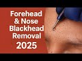 ULTIMATE Satisfying Forehead & Nose Blackhead Removal 2025