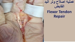 flexor tendon repair اصلاح اوتار اليد القابضة