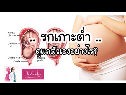 วีดีโอ: รกต่ำหมายความว่าอย่างไรในระหว่างตั้งครรภ์?