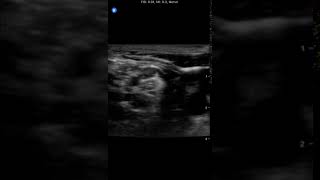 Interscalene | Clinical Image