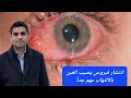 فيروس منتشر معدى جدا يصيب العين بالالتهاب مهم جدا 