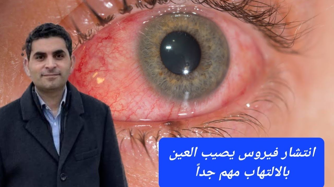فيروس منتشر معدى جداً يصيب العين بالالتهاب. مهم جداً.