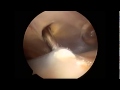 Evacuation arthroscopique de calcification paule  dr falcone clinique jouvenet